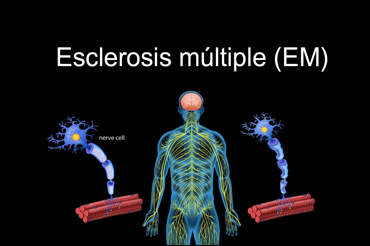 human anatomy multiple sclerosis 1308 14800 1