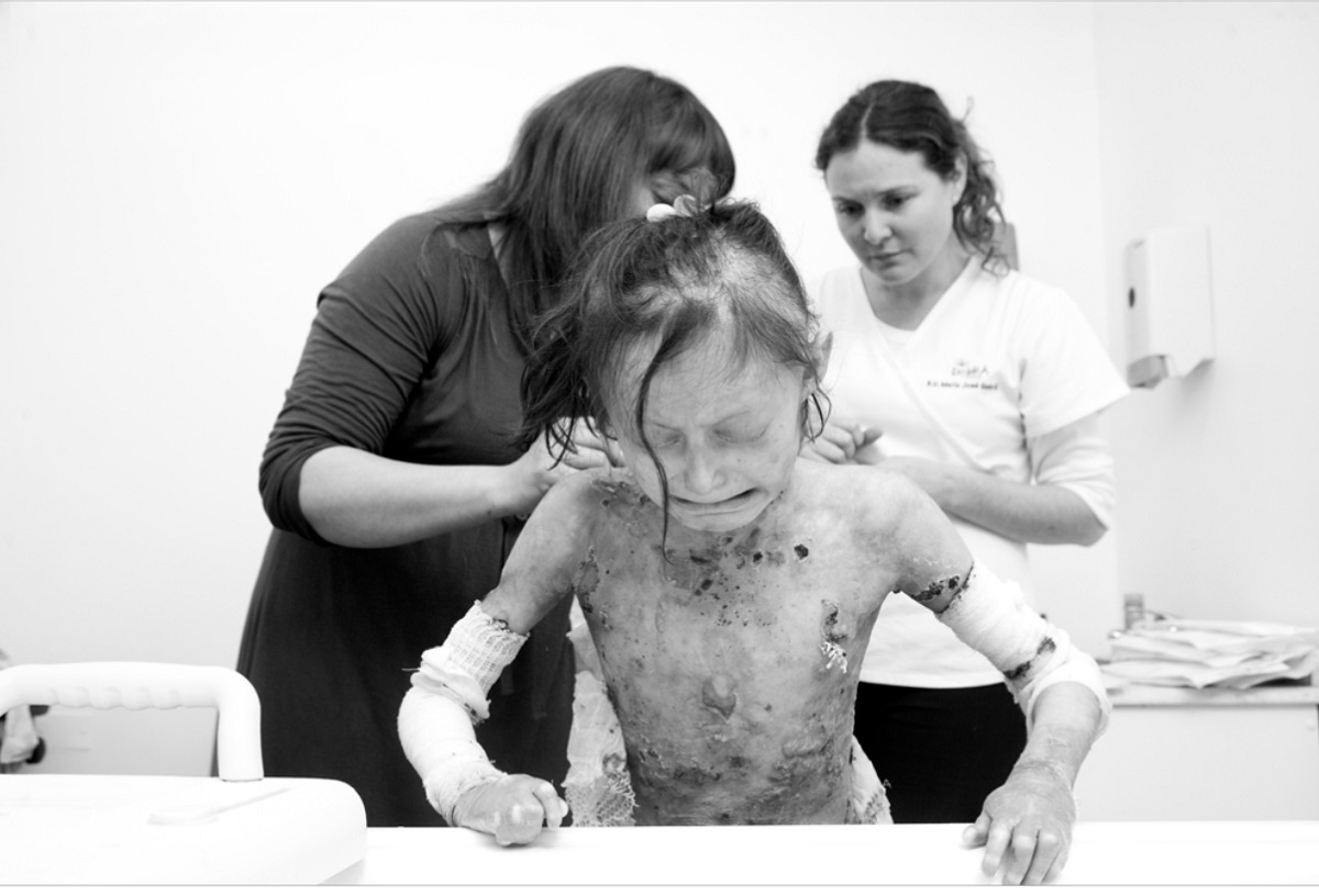 DÍA INTERNACIONAL DE LOS NIÑOS CON PIEL DE CRISTAl CONOCE ESTA ENFERMEDAD Y LOS BENEFICIOS DEL ALOE VERA PARA ESTOS PACIENTES 2