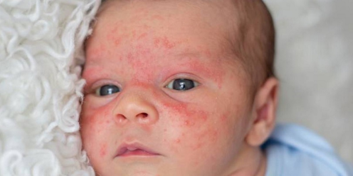 SABÍAS QUE EN CHILE 3 DE CADA 10 PERSONAS PADECEN DE DERMATITIS ATÓPICA 2