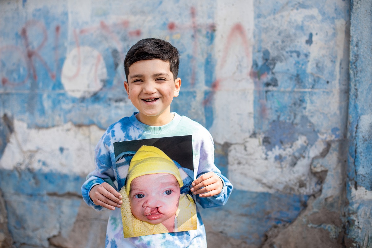EXPERTOS DE TODO EL MUNDO ASISTIRÁN AL PRIMER CONGRESO INTERNACIONAL DE SMILE TRAIN QUE SE REALIZARÁ EN CHILE 1
